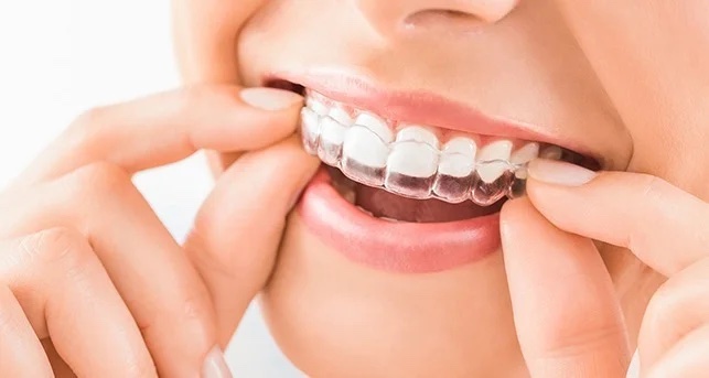 أخصائي أسنان يضع تقويماً شفافاً على الأسنان